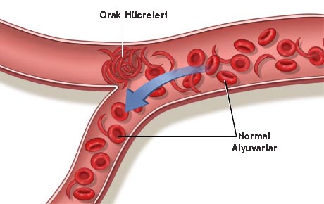 Orak Hücreli Anemi